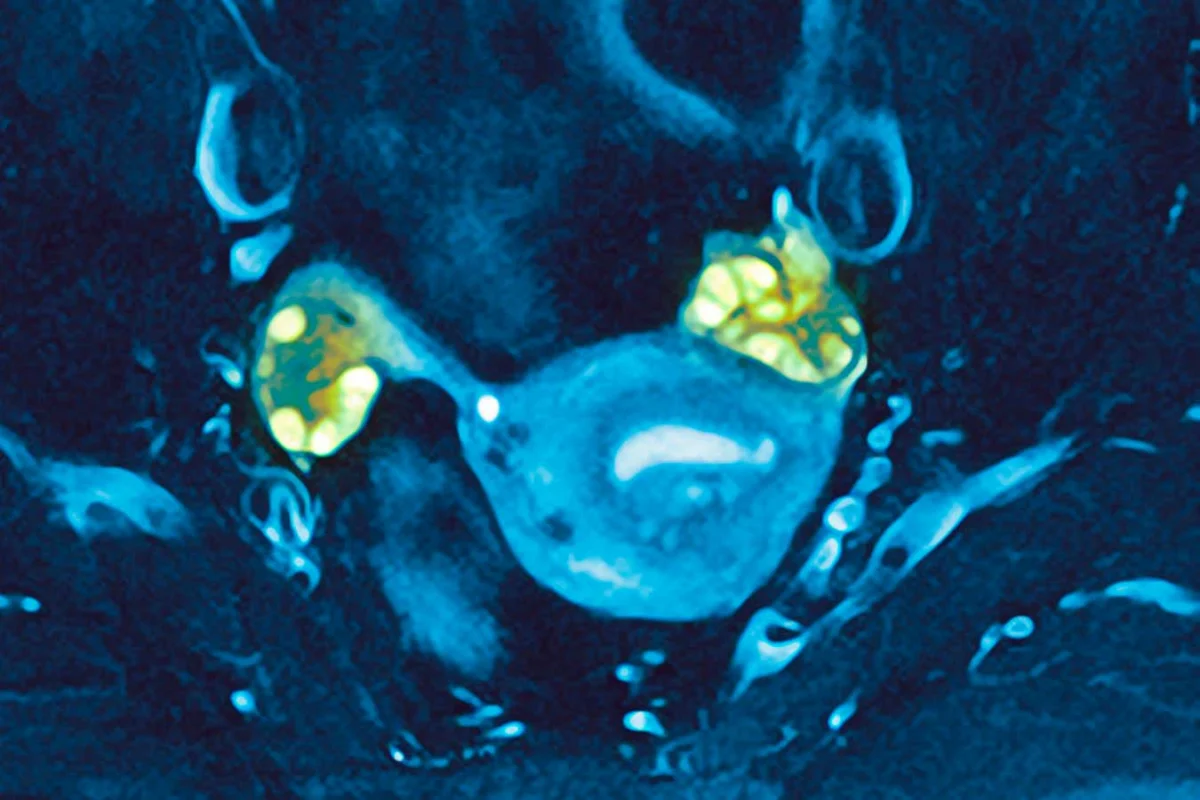 The "Evening Star" Phenomenon: Why PCOS May Offer Unexpected Biological Advantages Later in Life